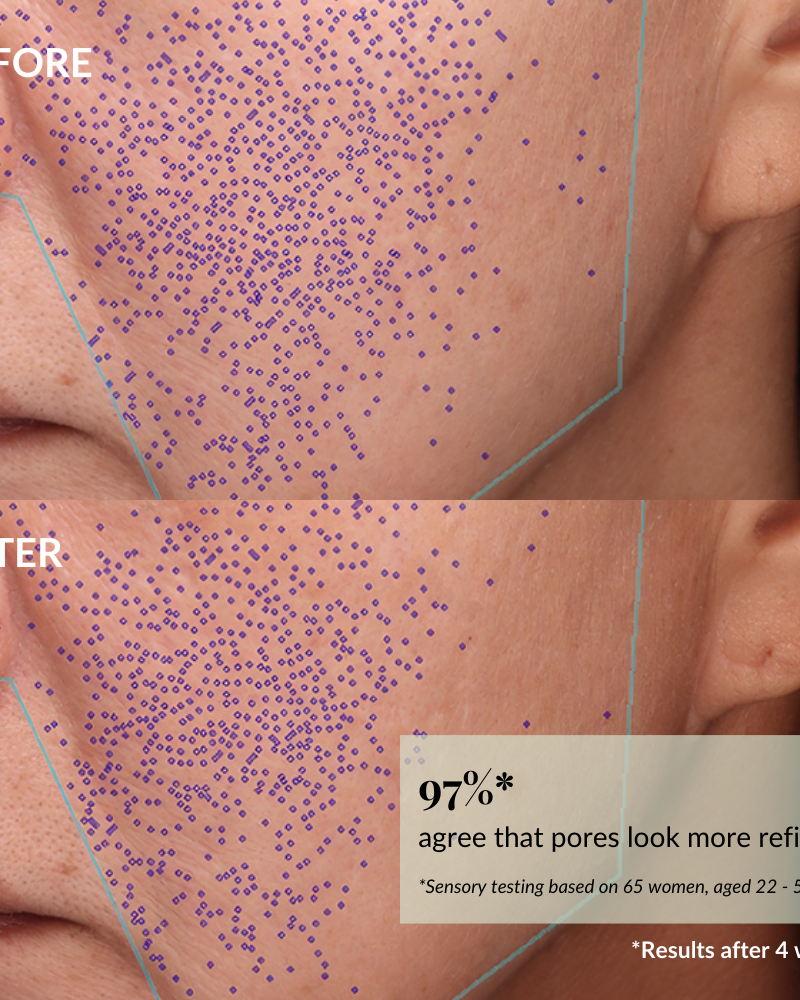 Close-up of a woman's cheek shows "before" with many purple dots and "after" with fewer, highlighting reduced skin pore visibility after 4 weeks of using IREN Shizen's START AFRESH DAILY Enzyme Powder Wash.